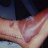 fracture blister 2002